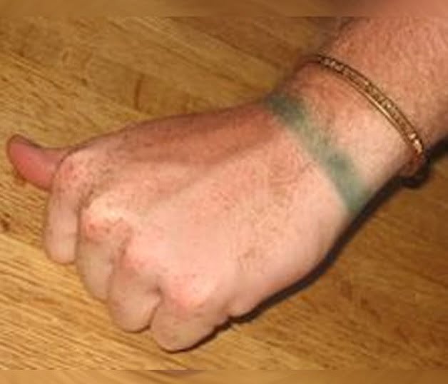 لکه های سبز دستبند مسی روی پوست